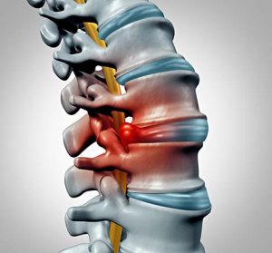 illustration of Disk-herniation