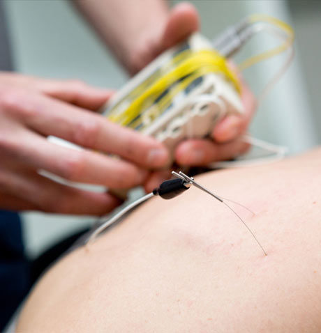 medical acupuncture needle