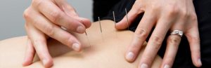 medical acupunture