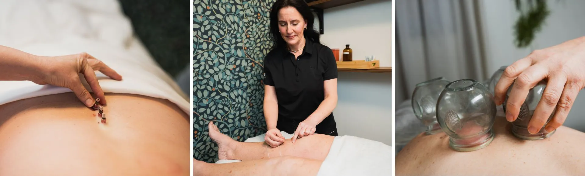 tcm acupunture